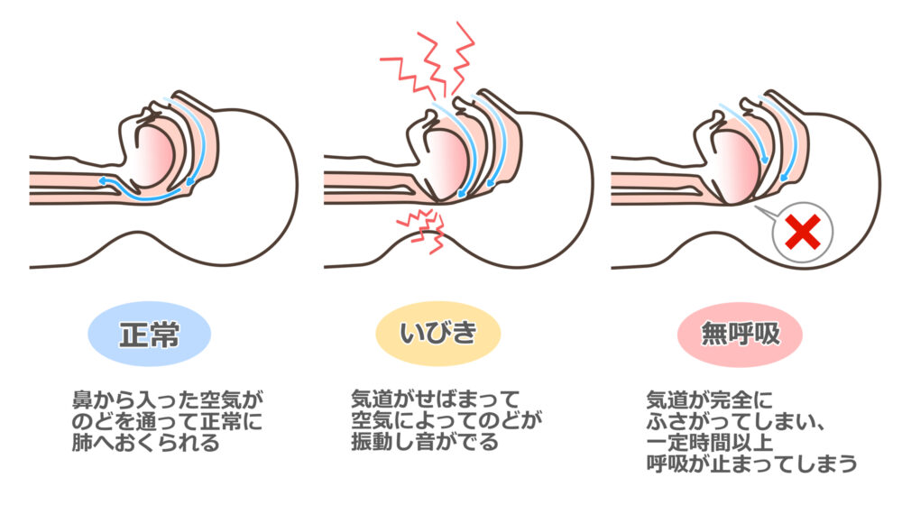 いびきを引き起こす病気・疾患1