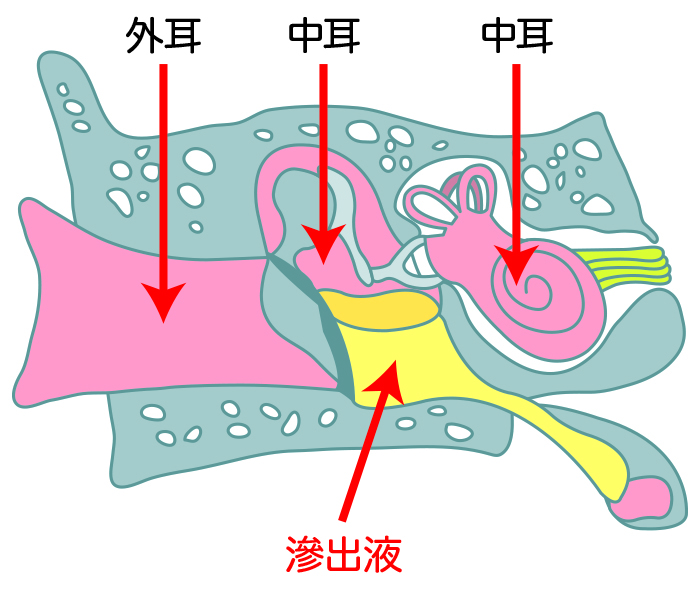 滲出性中耳炎とは